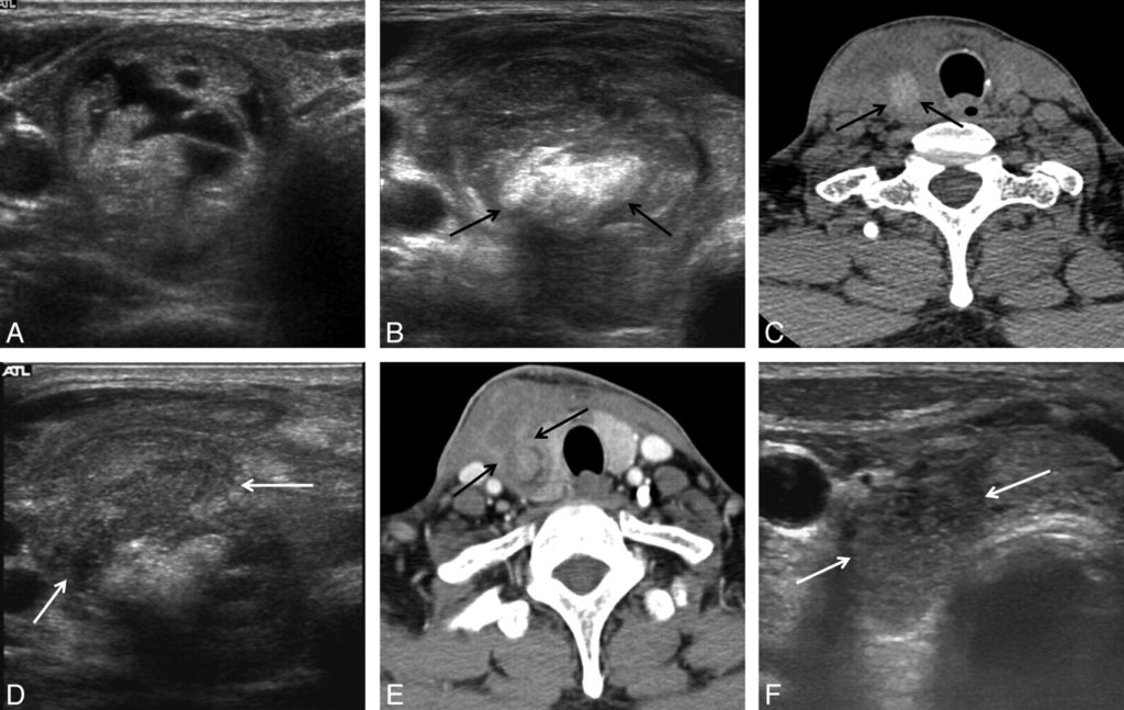 Thyroid Tumors after Radio-Frequency Ablation